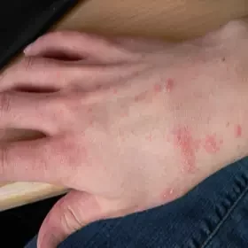Choroby na dłoniach świerzb