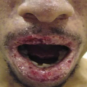 Choroby na ustach pęcherzyca zwykła