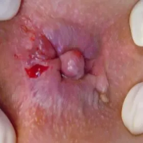 Choroby odbytu świąd szczelina odbytu 