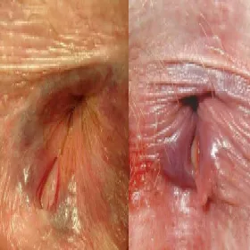 Choroby odbytu szczelina odbytu 