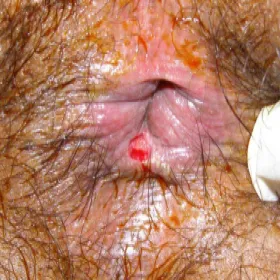 Choroby odbytu zdjęcia szczelina odbytu 