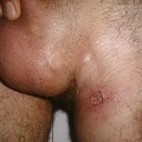 Choroby okolic intymnych choroba Behçeta 