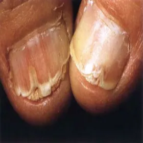 Choroby paznokci choroba Dariera