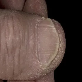 Choroby paznokci paznokcie łyżeczkowate