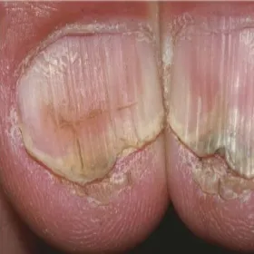 Choroby paznokci u nóg koilonychia