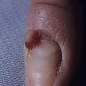 Choroby paznokcia palca u ręki ziarniniak