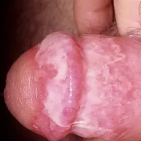 Choroby penisa grzybica