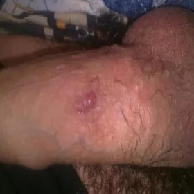 Choroby penisa zapalenie mieszków włosowych