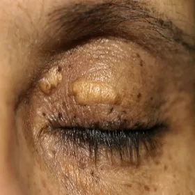 Choroby powiek zdjęcia objawy żółtaki 