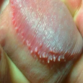 Choroby prącia grudki perliste