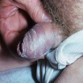 Choroby prącia mięsak Kaposiego 