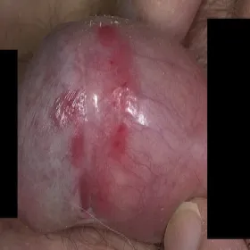 Choroby prącia obrazy choroba Bowena