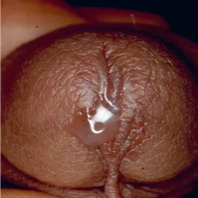 Choroby prącia rzeżączka obrazy