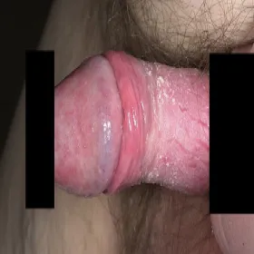 Choroby prącia u dorosłego zapalenie napletka