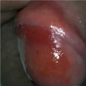 Choroby prącia zapalenie plazmakomórkowe żołędzi Zoon