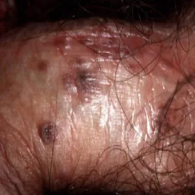 Choroby przenoszone drogą płciową u mężczyzn