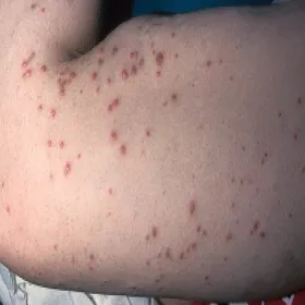 Choroby skórne choroba Kyrle