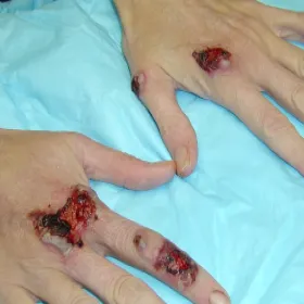 Choroby skórne dłoni piodermia zgorzelinowa