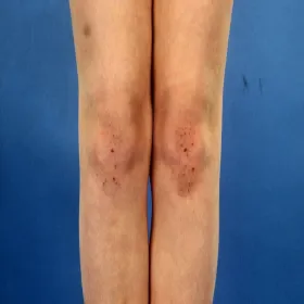 Choroby skórne na nogach choroba Duhringa 