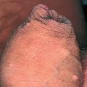 Choroby skórne prącia mięczak zakaźny