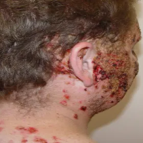 Choroby skórne twarzy pęcherzyca zwykła