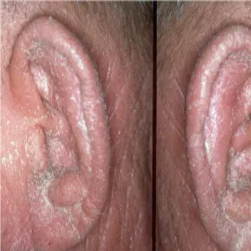 Choroby skórne uszu zespół Sezary’ego 