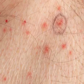 Choroby skóry choroba Grovera