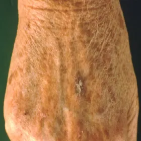 Choroby skóry dłoni rogowacenie słoneczne