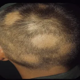 Choroby skóry głowy łysienie plackowate