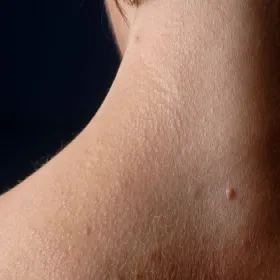 Choroby skóry liszaj lśniący 