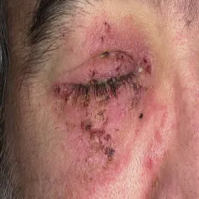 choroby skóry liszajec