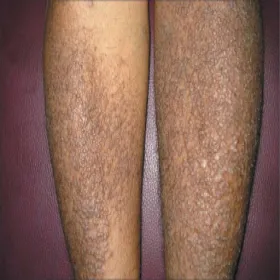 Choroby skóry nóg choroba amyloidozy skóry 