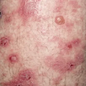 Choroby skóry pęcherzowy liszaj płaski czerwony