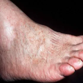 Choroby skóry stóp choroba Schamberga