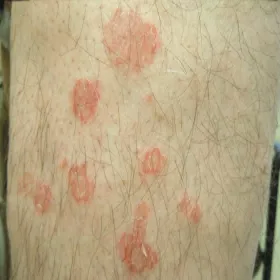 Choroby skóry wyprysk mikrobowy