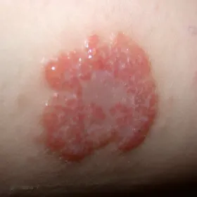 Choroby skóry wyprysk pieniążkowaty