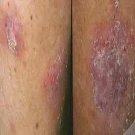 Choroby skóry wyprysk pieniążkowy