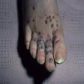 Choroby stóp mięsak Kaposiego 