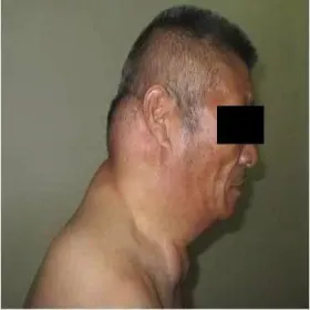 Choroby u nadużywających alkohol choroba Madelunga