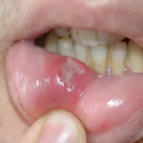 Choroby ust warg zdjęcia choroba Behçeta 