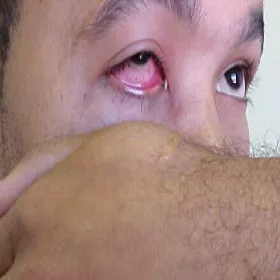 Choroby weneryczne rzeżączka oko