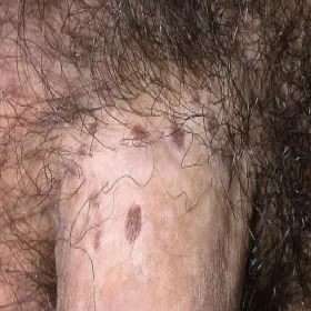 Choroby weneryczne zdjęcia objawy grudkowatość bowenoidalna 