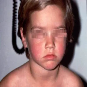 Choroby dziecięce rumień zakaźny