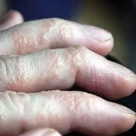 Choroby skórne na palcach