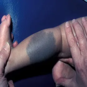 Ciemna duża plama na nodze u dziecka