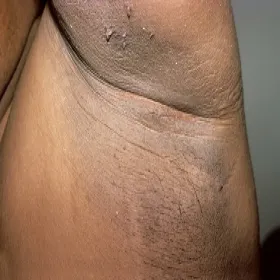 Ciemna skóra pod pachami u mężczyzn