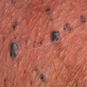 Ciemne guzki na skórze rogowiec krwawy