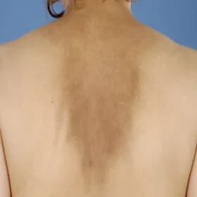 Ciemne plamy na skórze pleców choroba amyloidozy skóry 