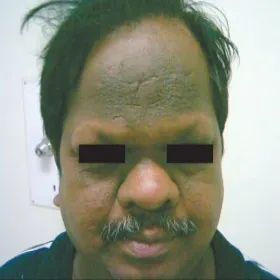 Ciemne plamy na twarzy choroba rogowacenie ciemne