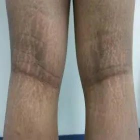 Ciemne plamy na nogach choroba rogowacenie ciemne